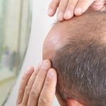 4 Things You Didn't Know About Stem Cell Hair Restoration