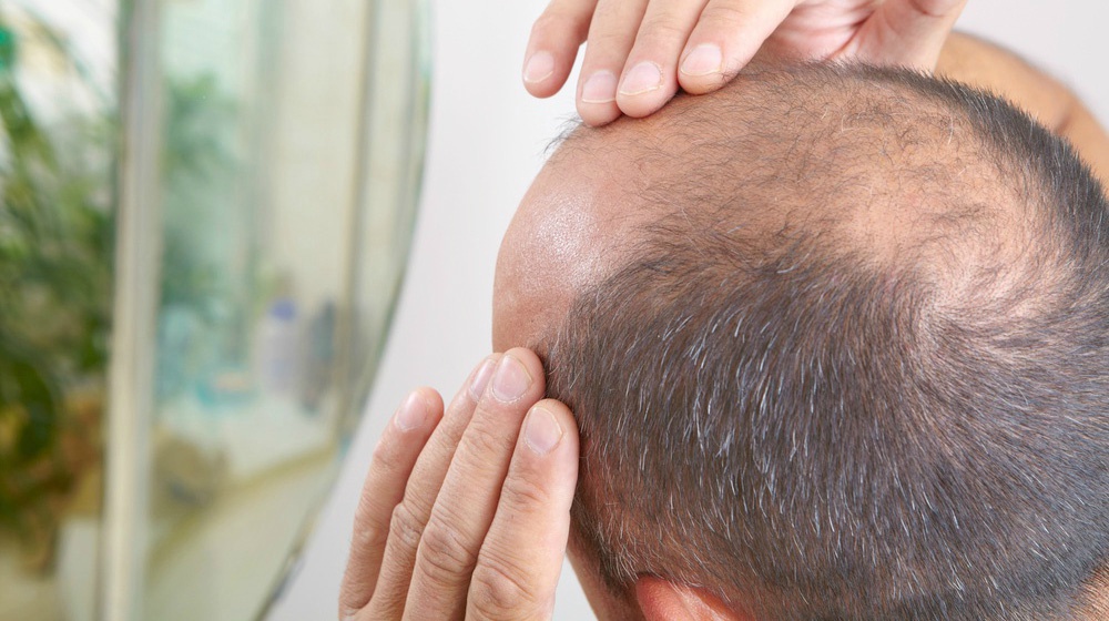 4 Things You Didn't Know About Stem Cell Hair Restoration